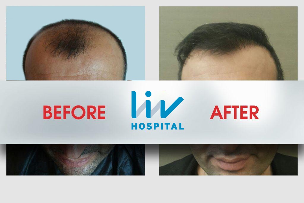 FUE — LIV Hospital