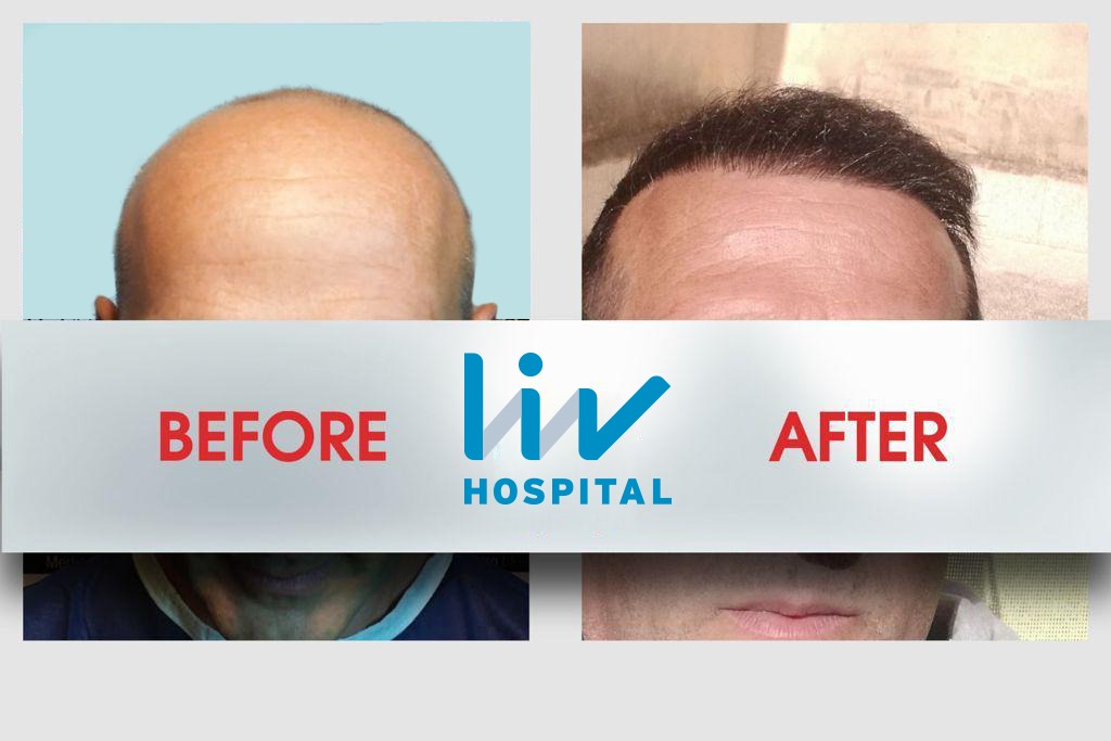 FUE — LIV Hospital