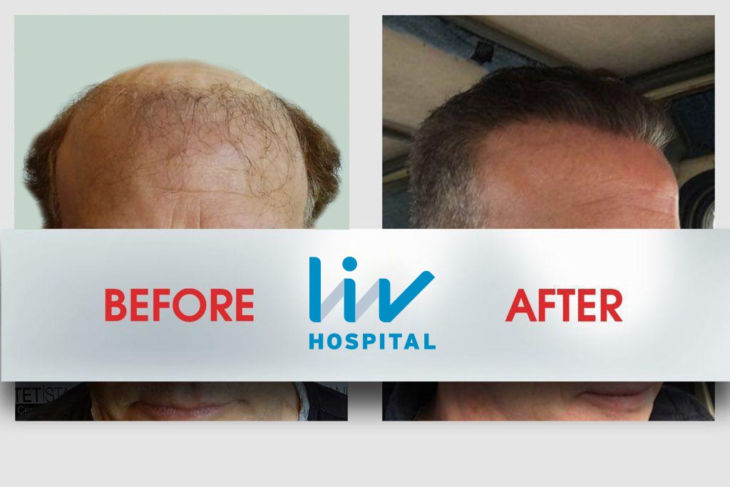 FUE — LIV Hospital