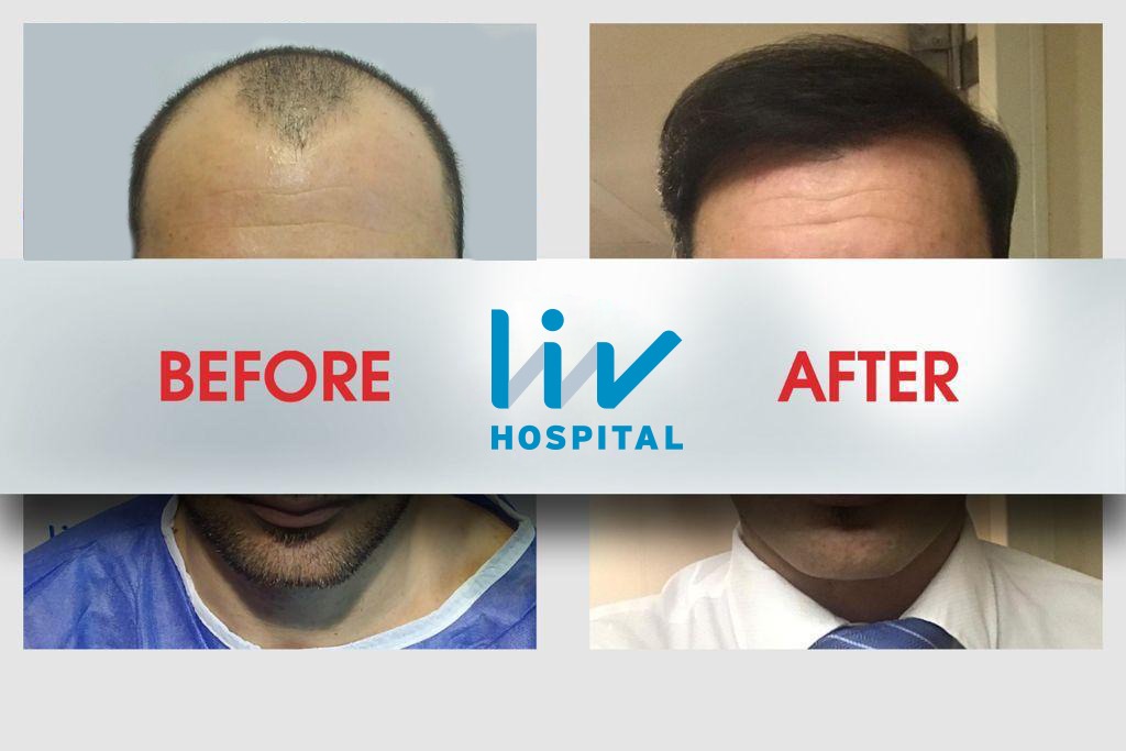 FUE — LIV Hospital