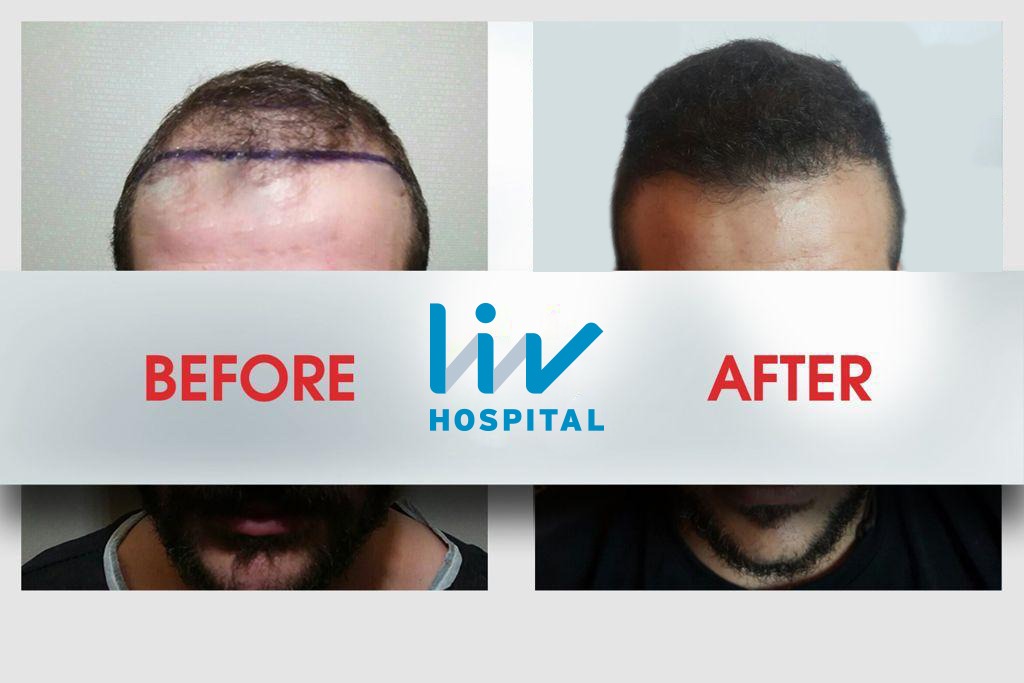 FUE — LIV Hospital
