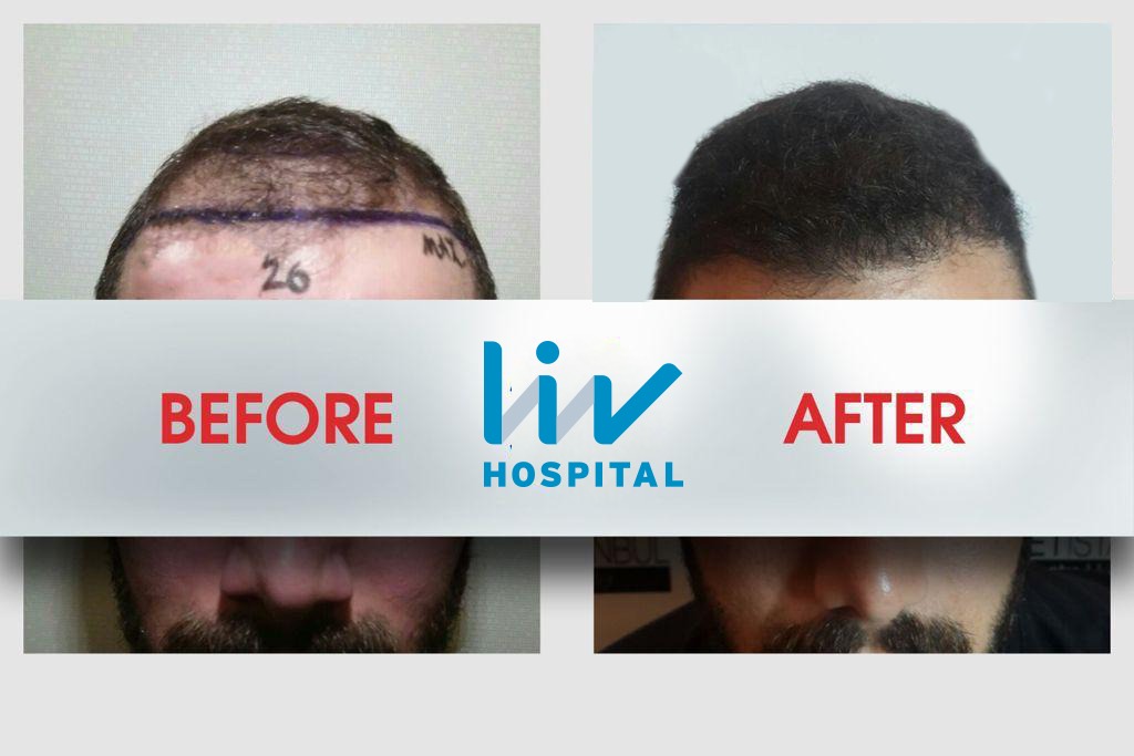 FUE — LIV Hospital