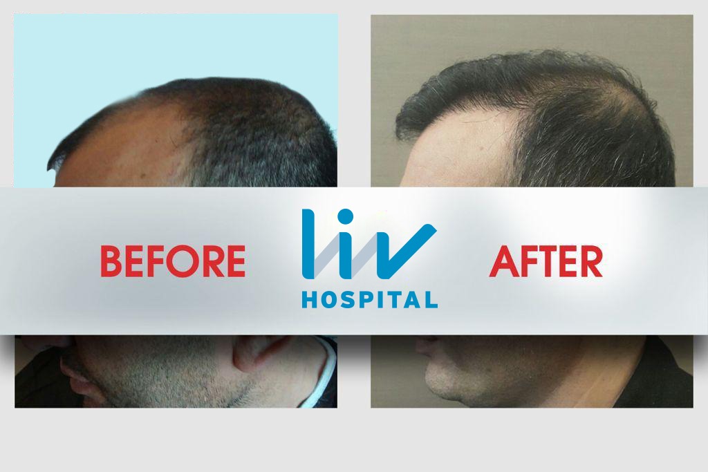 FUE — LIV Hospital