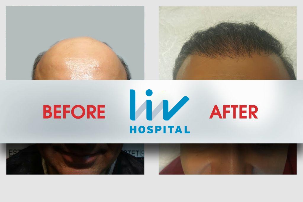 FUE — LIV Hospital