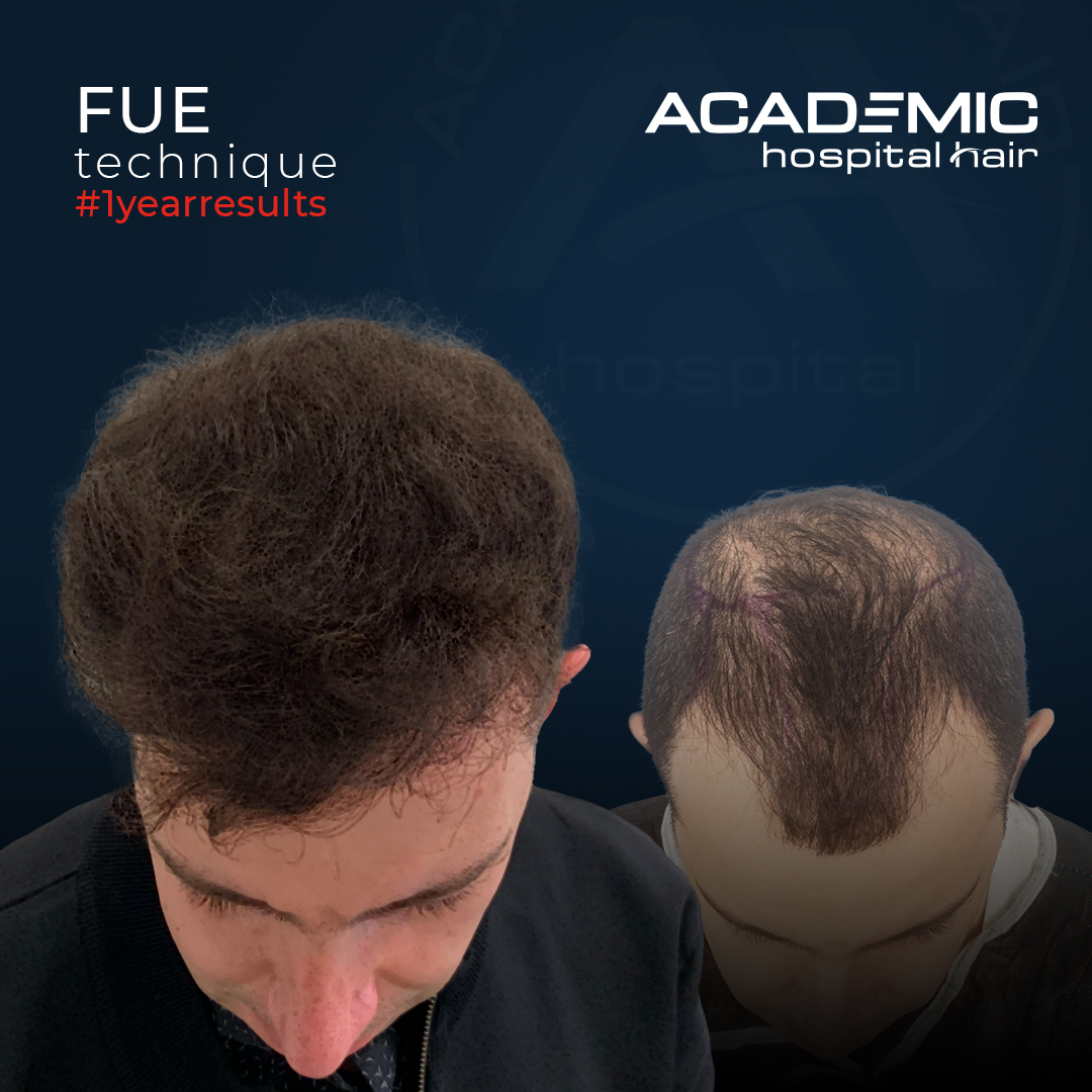 FUE — Academic Esthetics