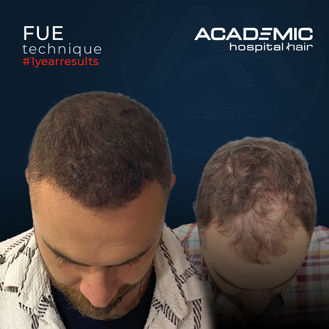 FUE — Academic Esthetics