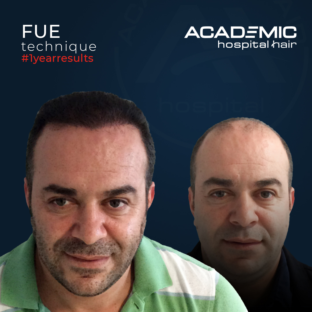 FUE — Academic Esthetics