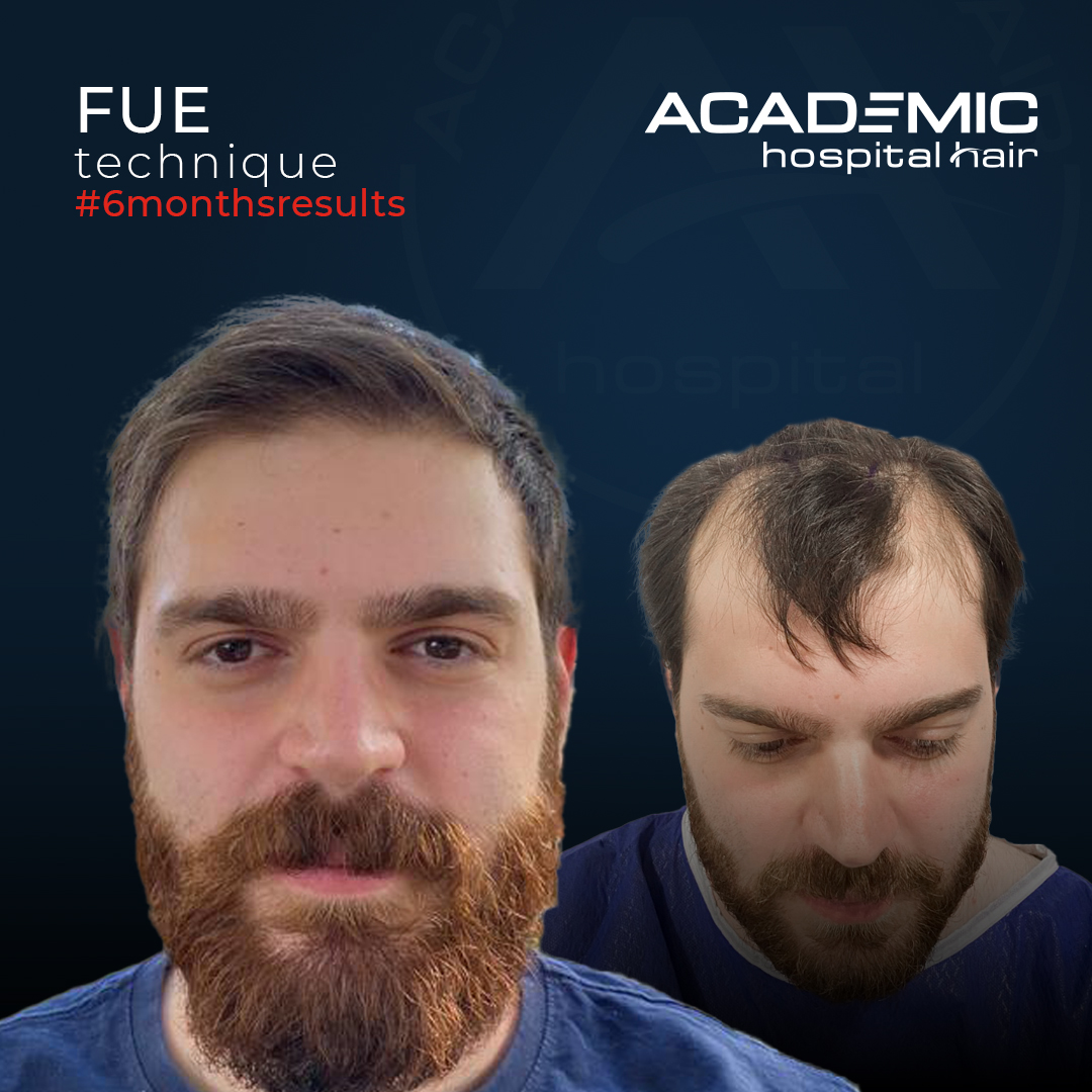FUE — Academic Esthetics