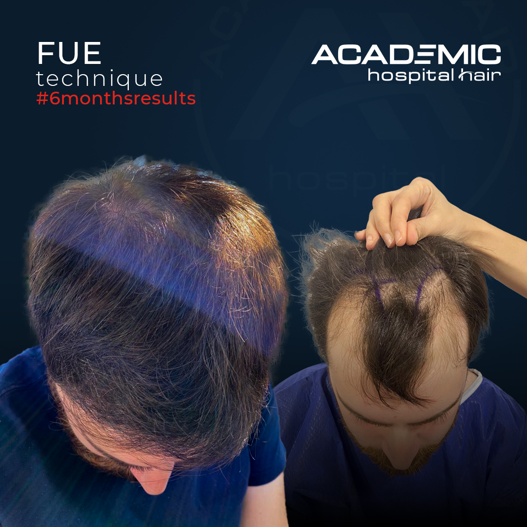 FUE — Academic Esthetics