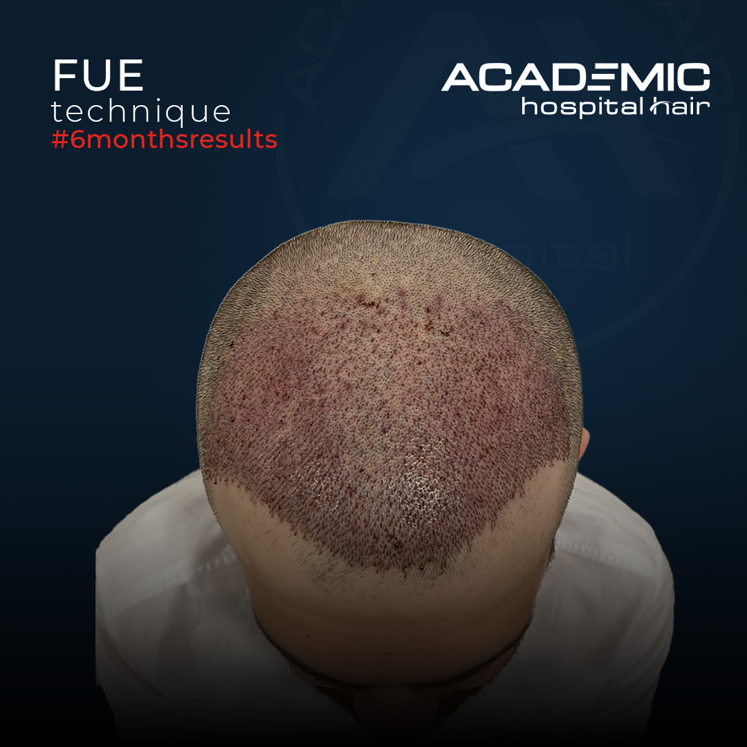 FUE — Academic Esthetics
