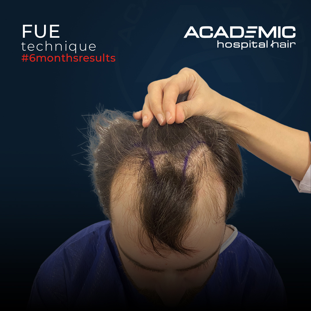 FUE — Academic Esthetics