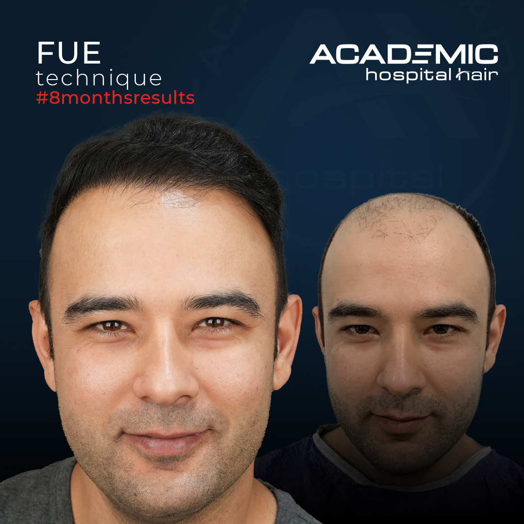 FUE — Academic Esthetics