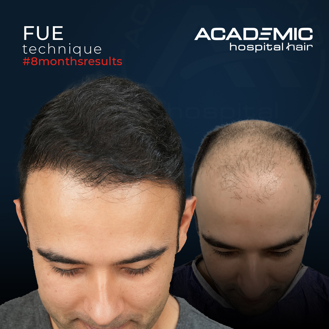 FUE — Academic Esthetics