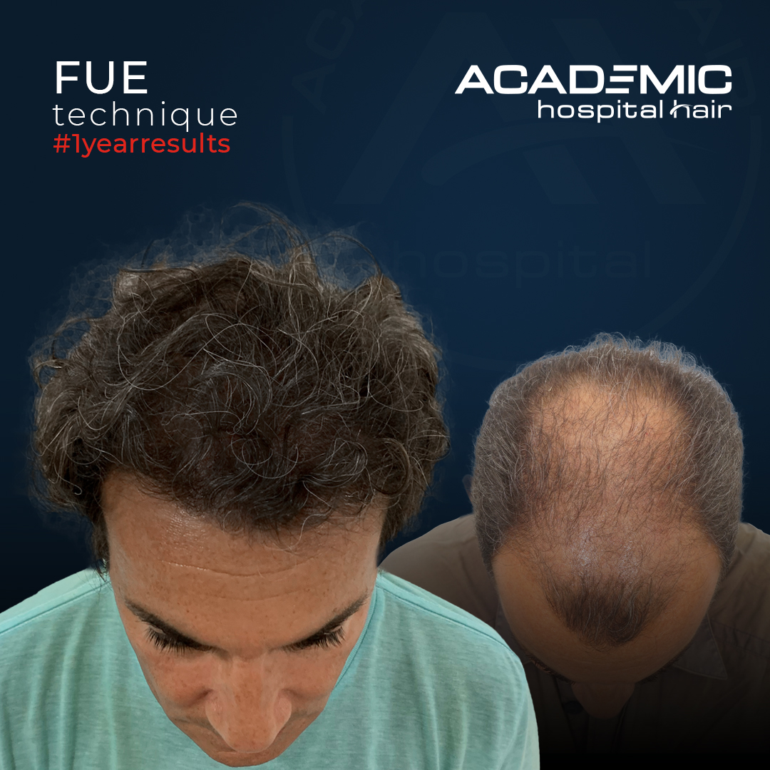 FUE — Academic Esthetics