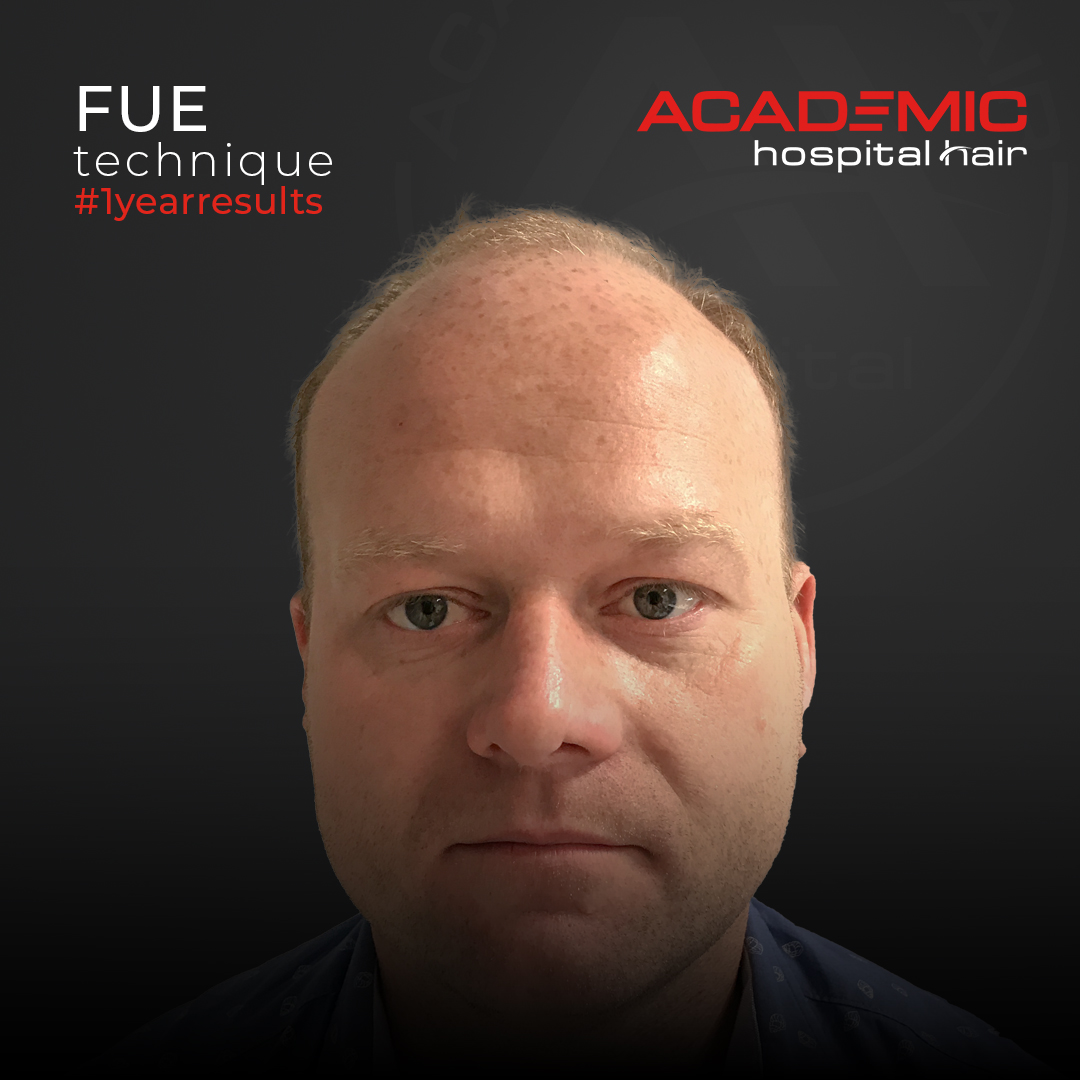 FUE — Academic Esthetics