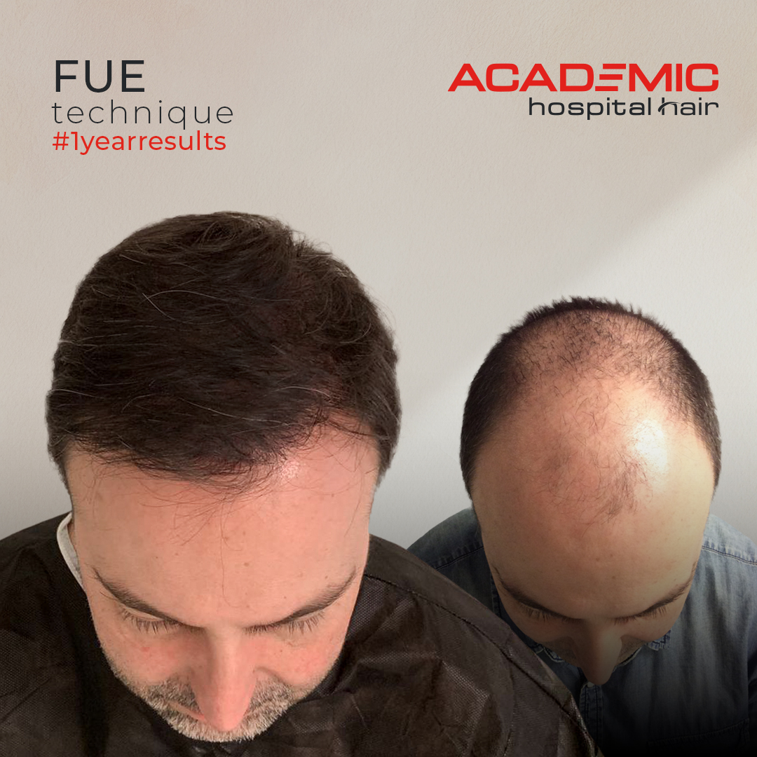 FUE — Academic Esthetics