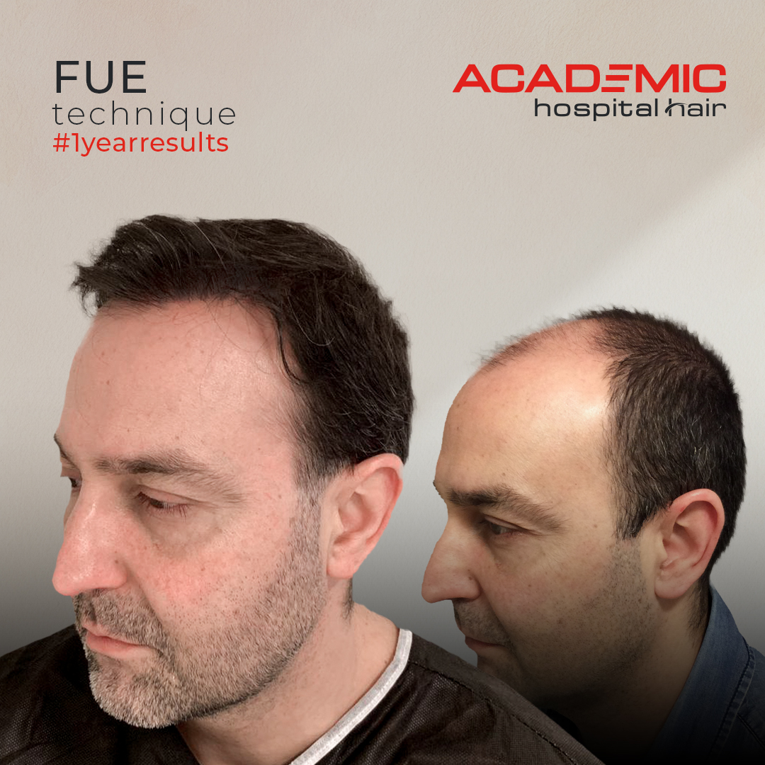 FUE — Academic Esthetics