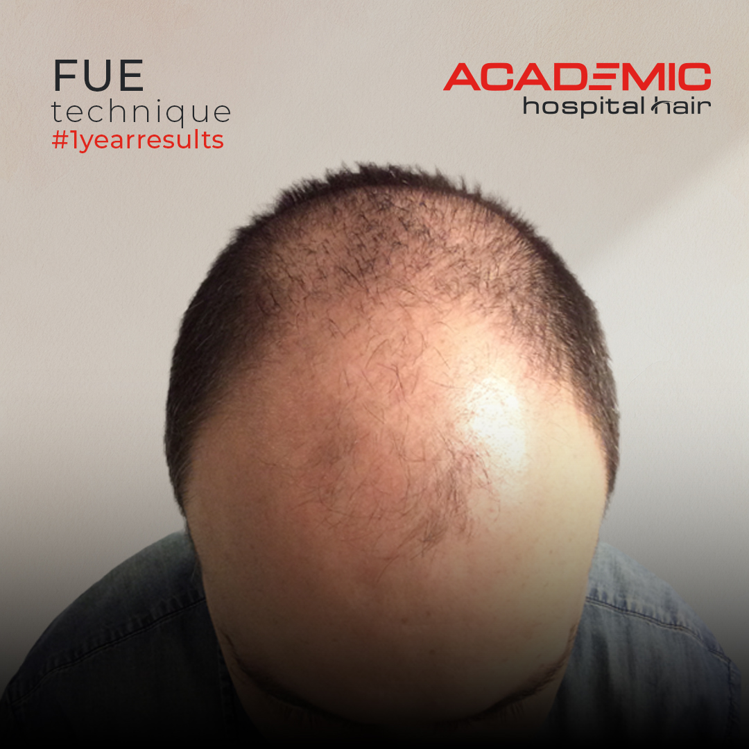 FUE — Academic Esthetics