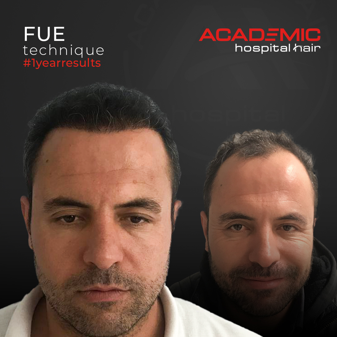 FUE — Academic Esthetics