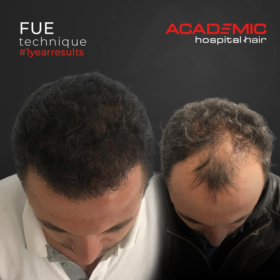 FUE — Academic Esthetics