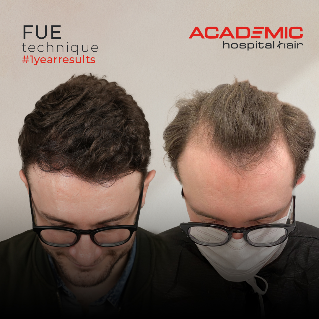 FUE — Academic Esthetics