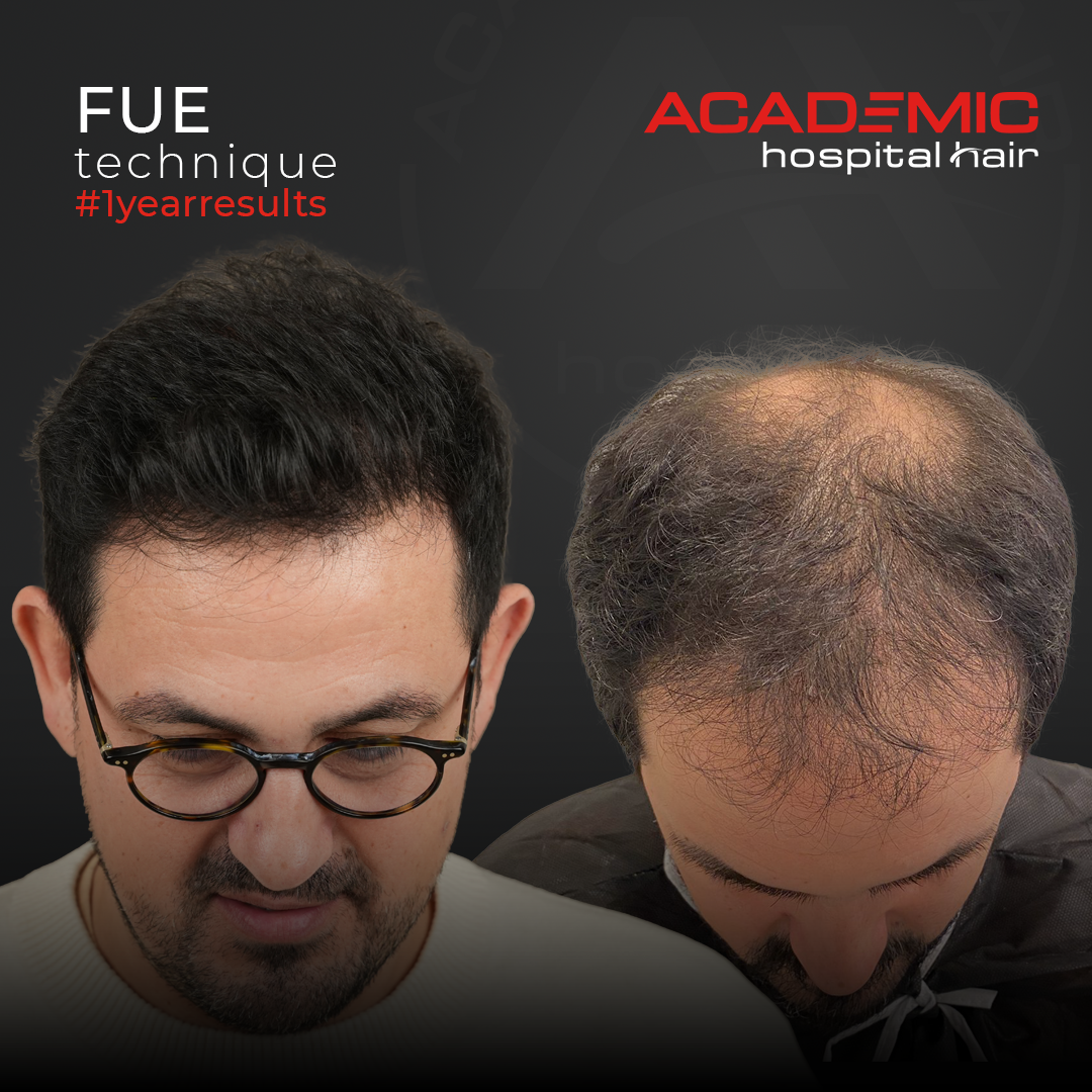 FUE — Academic Esthetics
