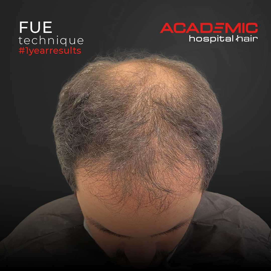 FUE — Academic Esthetics