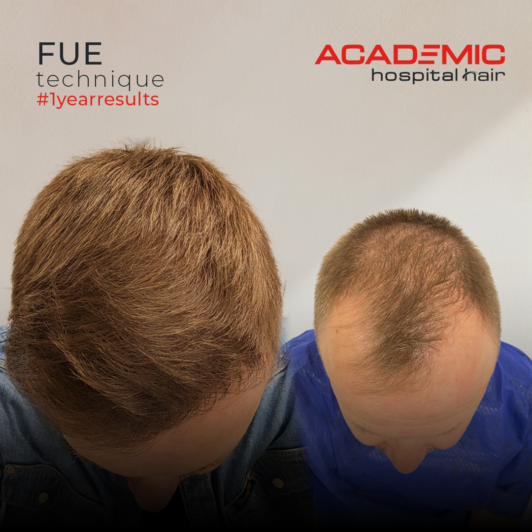 FUE — Academic Esthetics