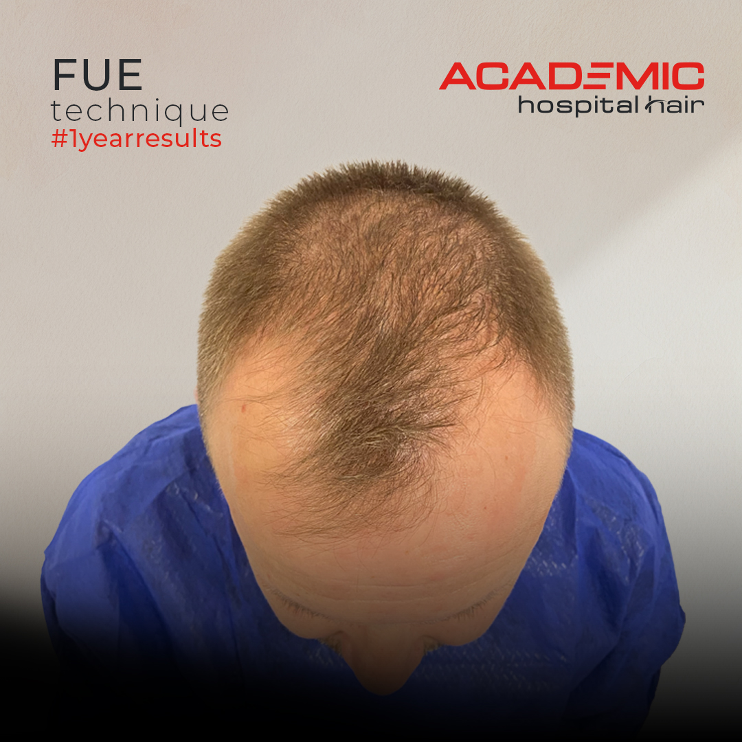 FUE — Academic Esthetics