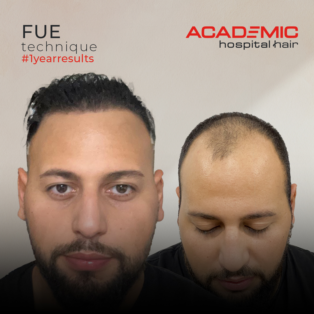 FUE — Academic Esthetics