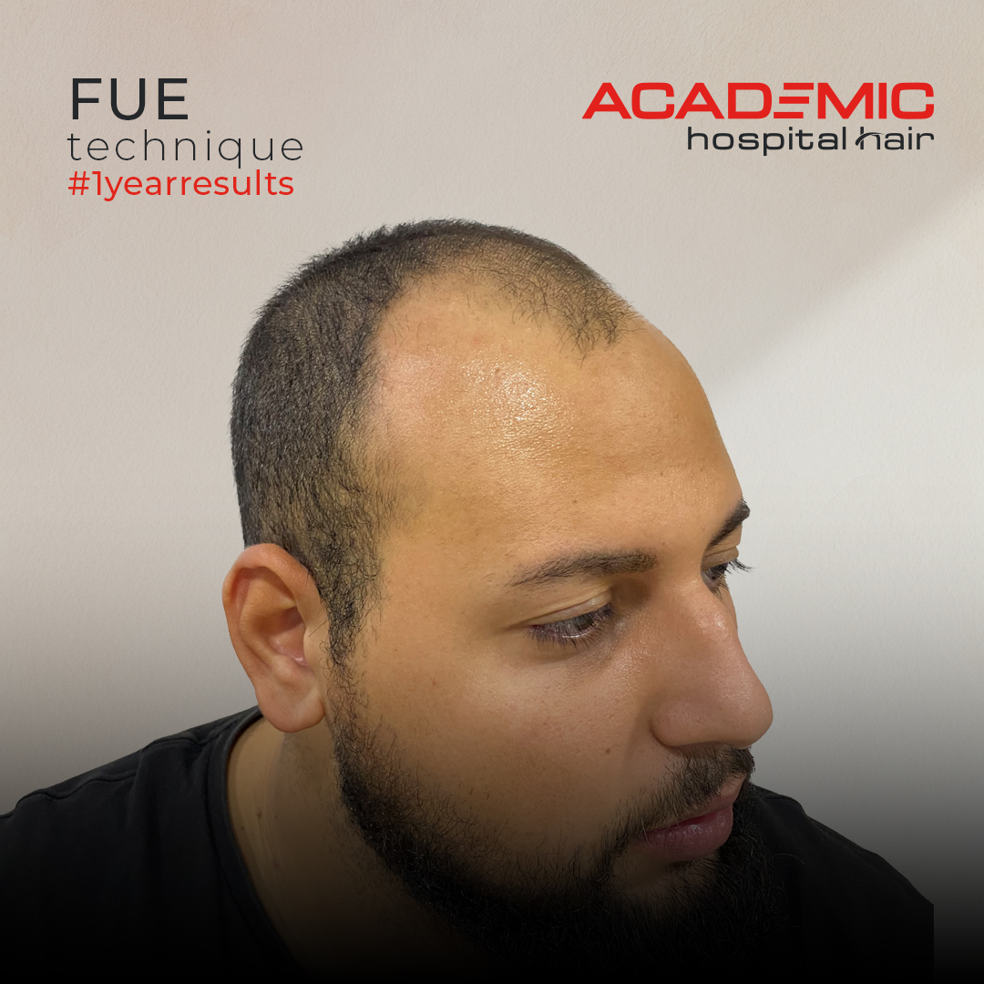 FUE — Academic Esthetics