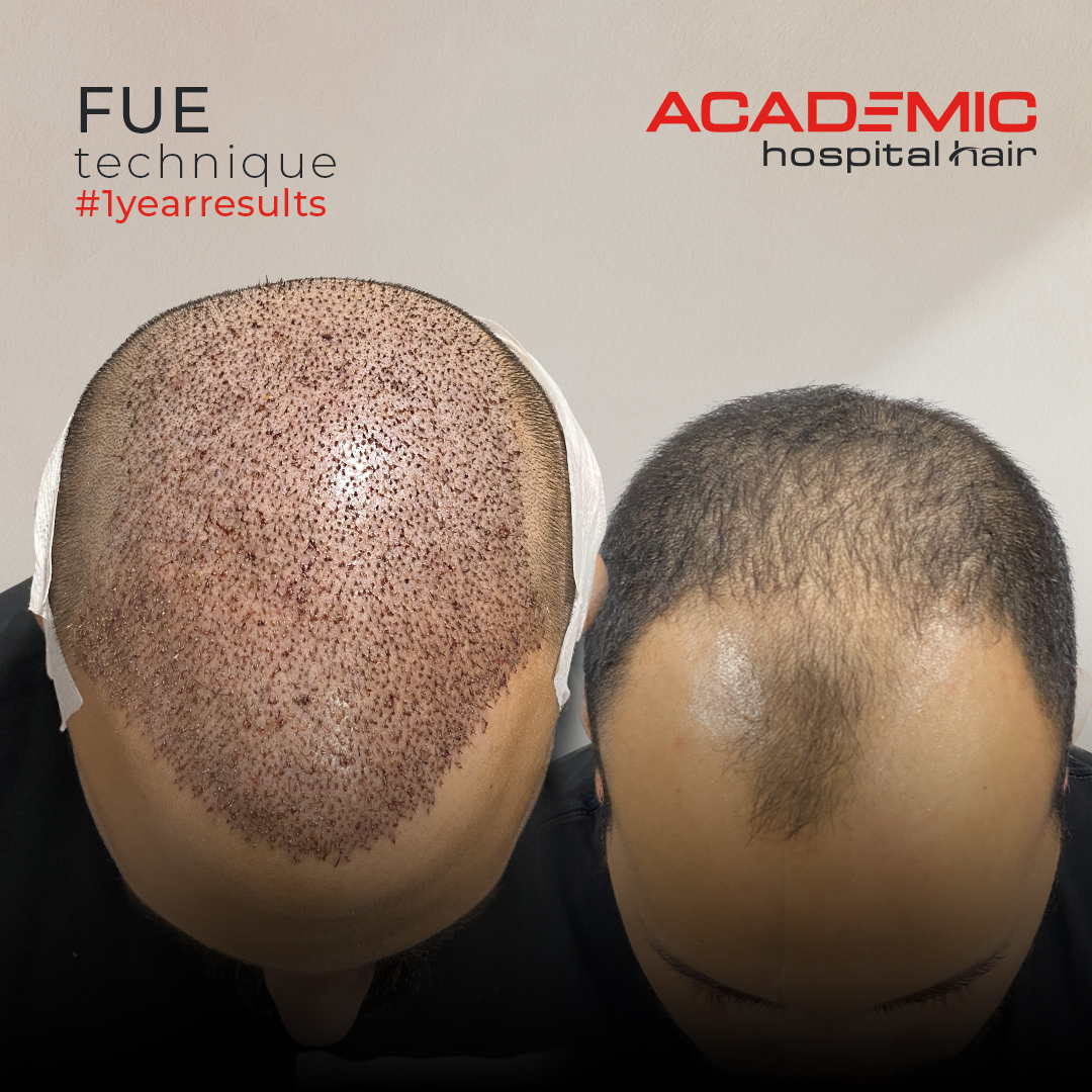 FUE — Academic Esthetics