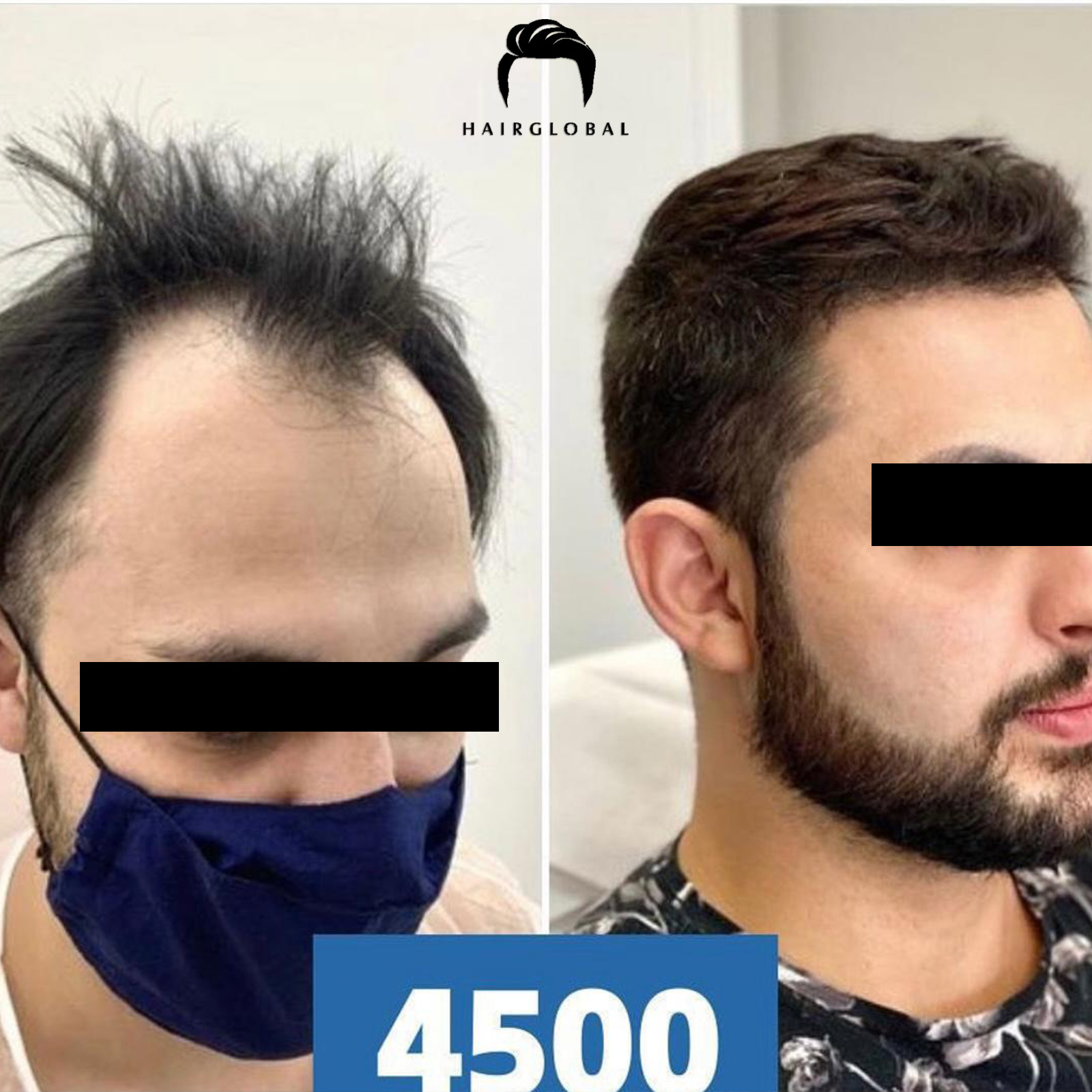 FUE — HairGlobal