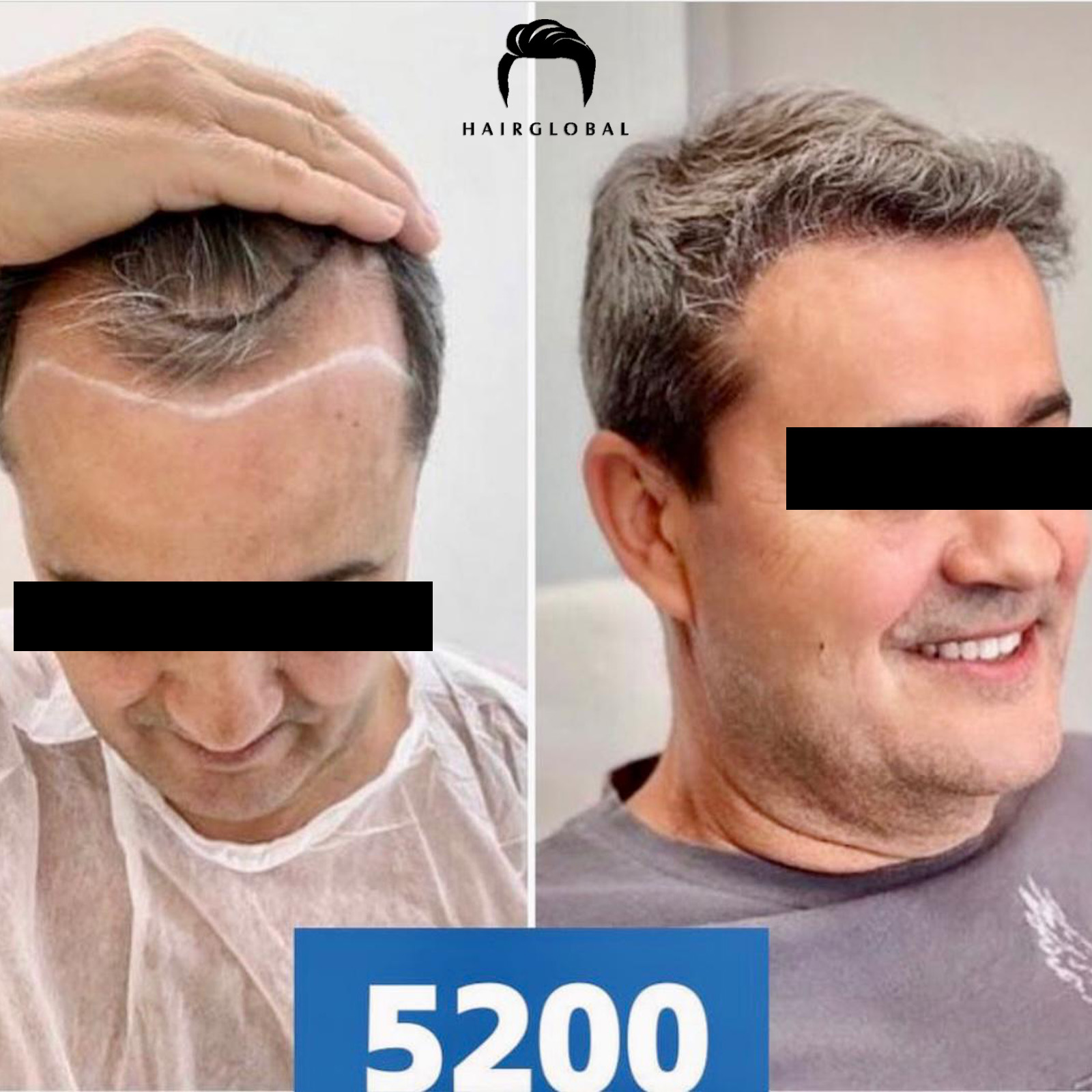 FUE — HairGlobal