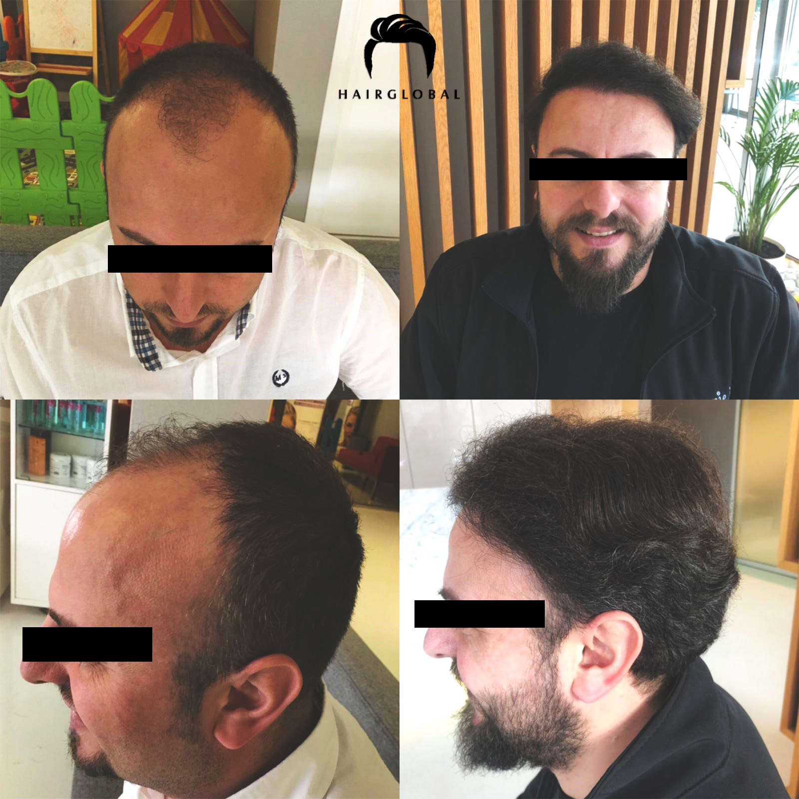 FUE — HairGlobal
