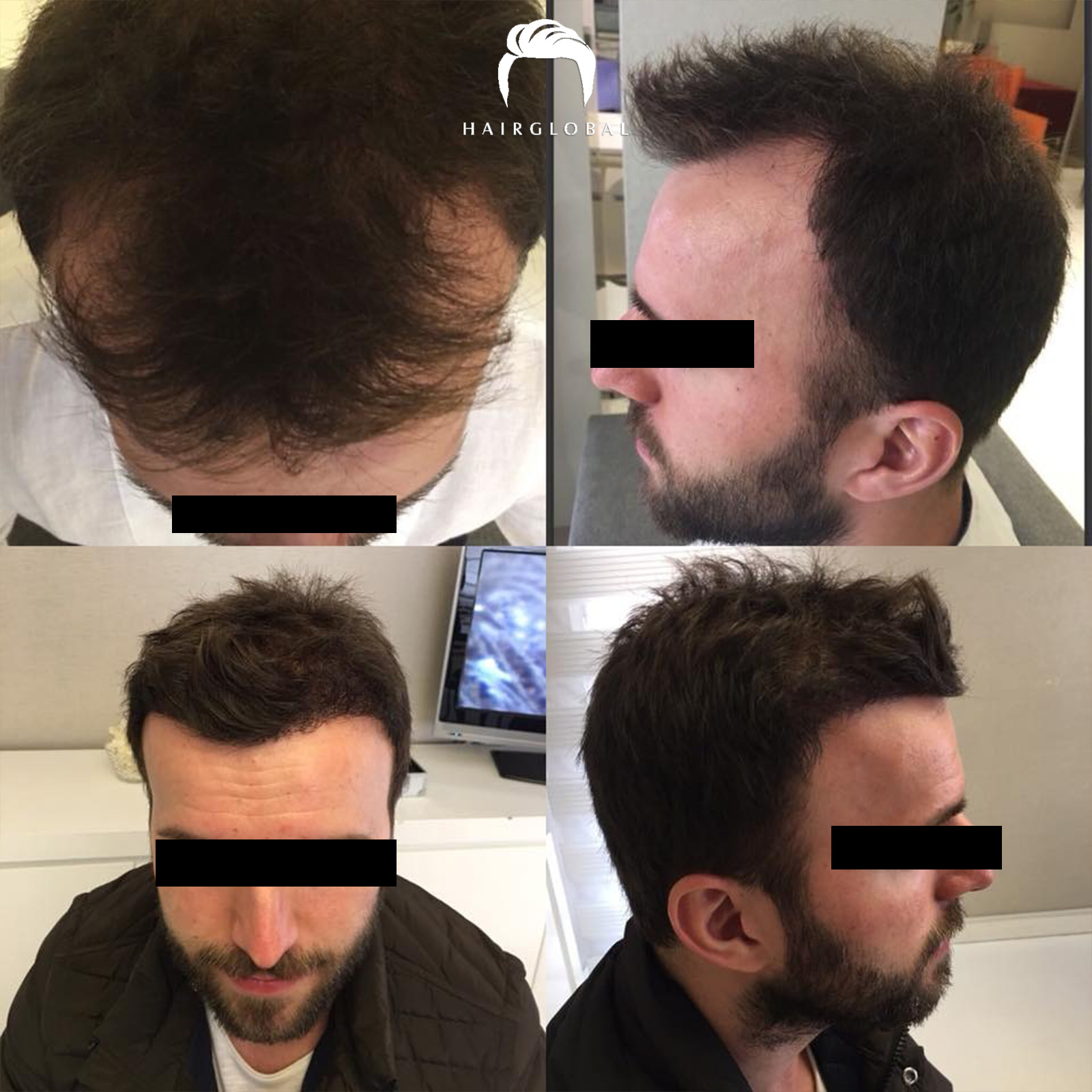 FUE — HairGlobal