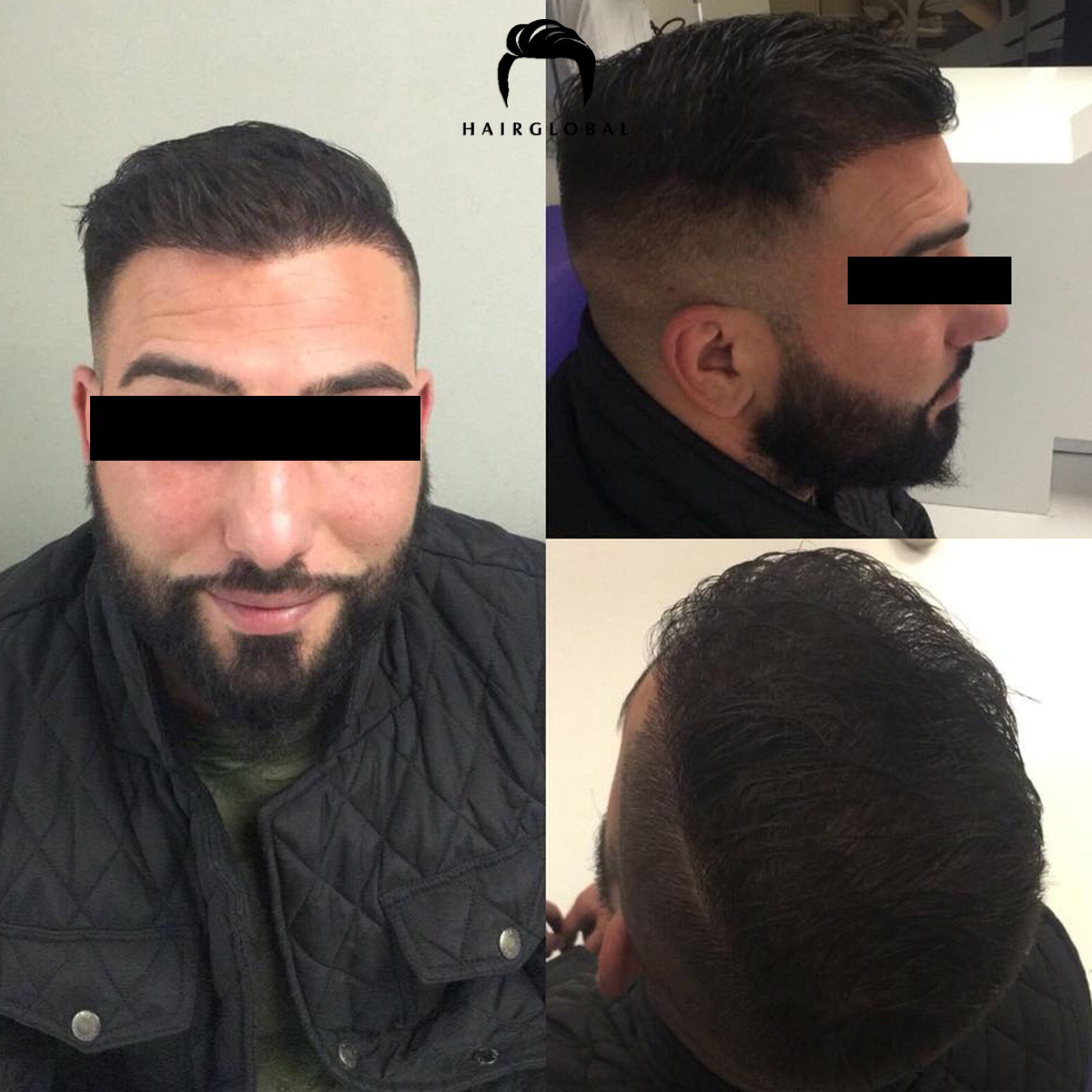 FUE — HairGlobal