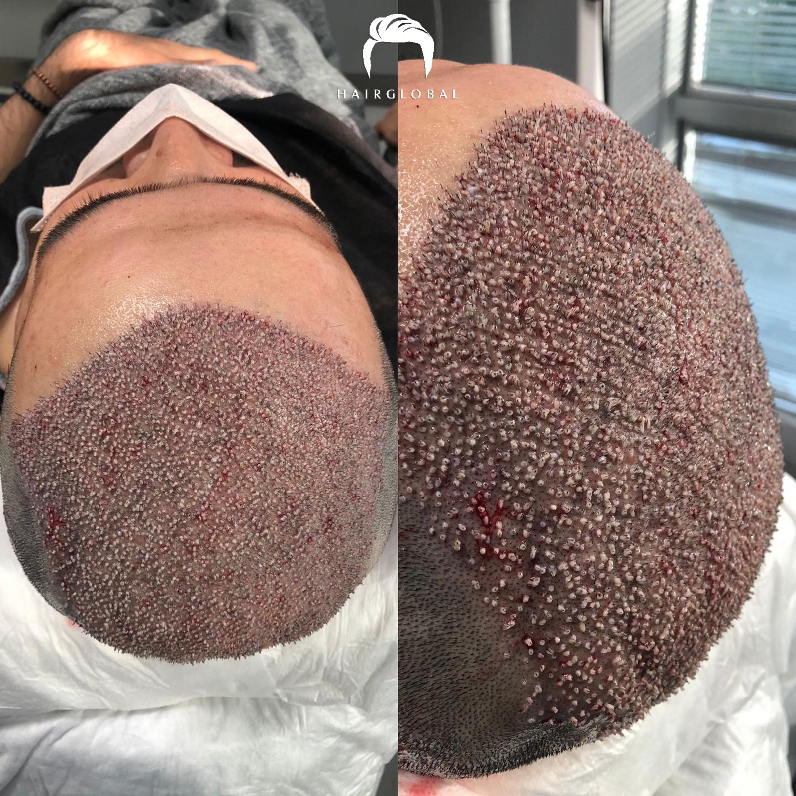 FUE — HairGlobal