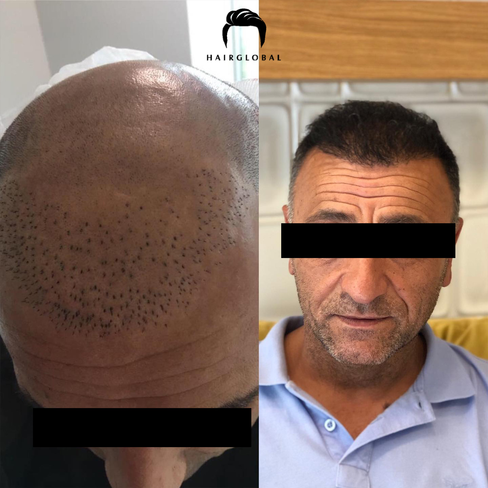 FUE — HairGlobal