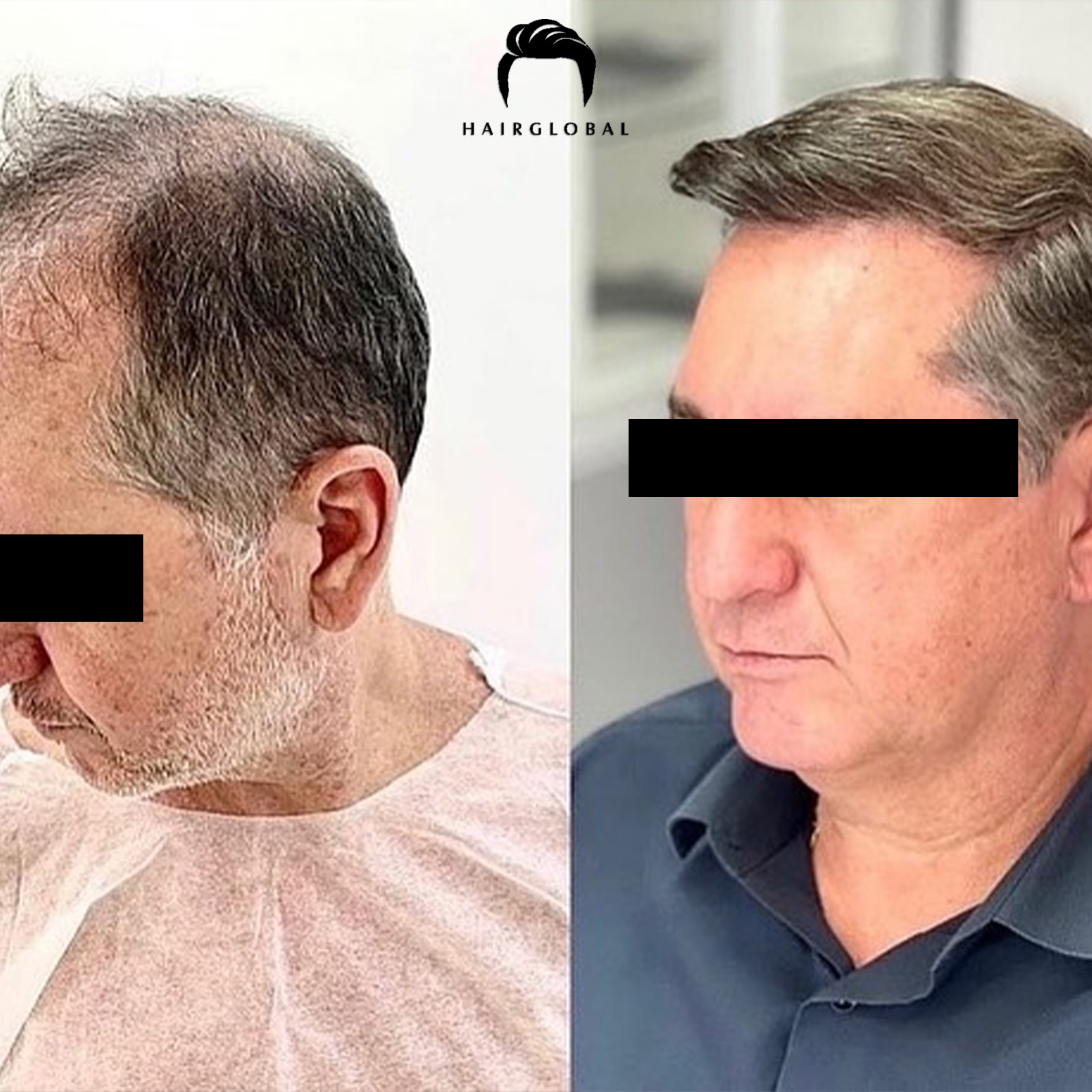 FUE — HairGlobal