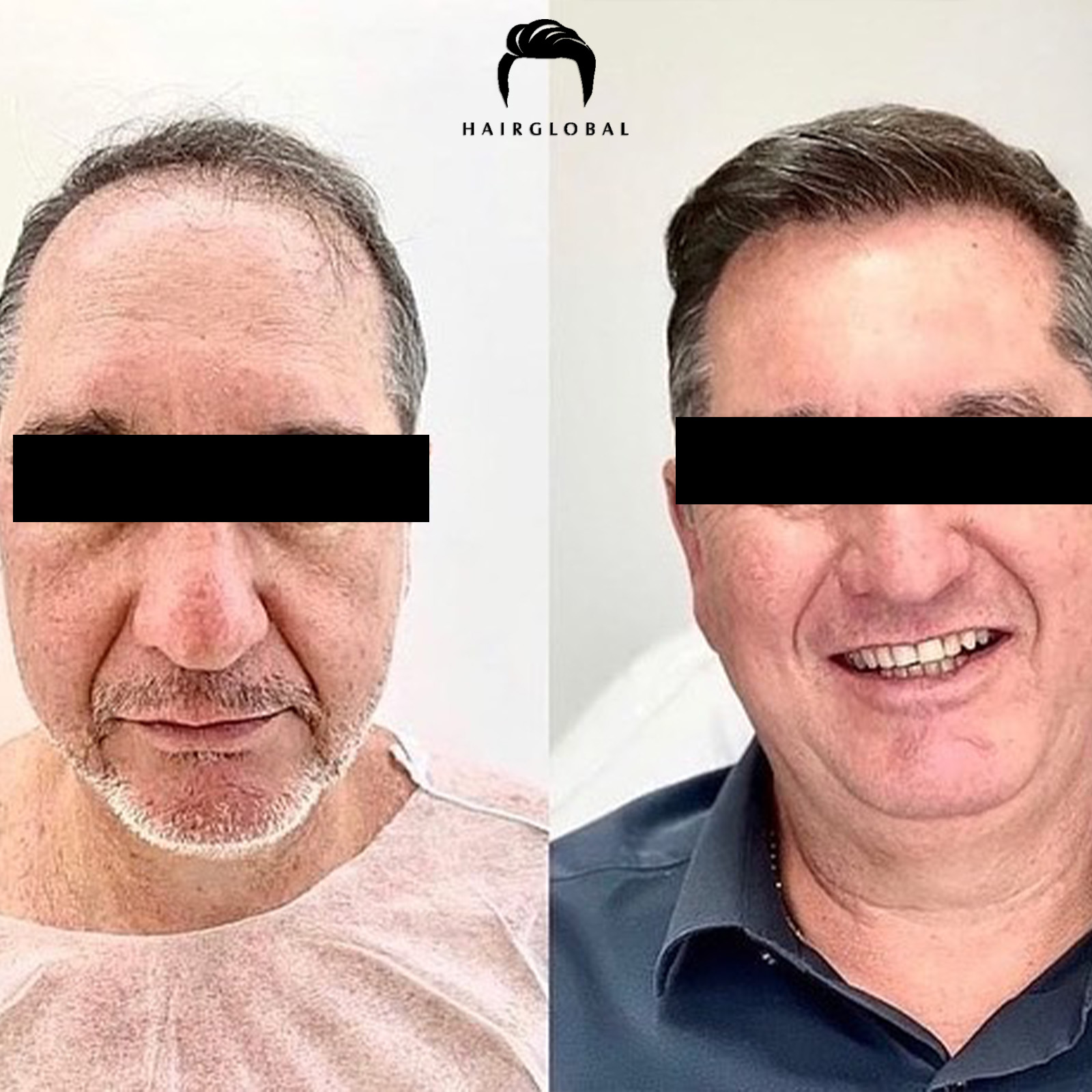 FUE — HairGlobal