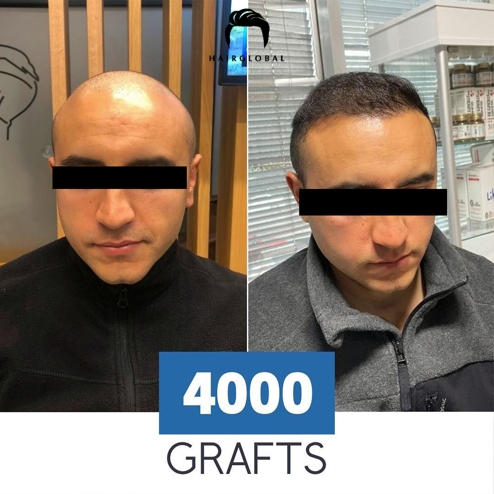 FUE — HairGlobal
