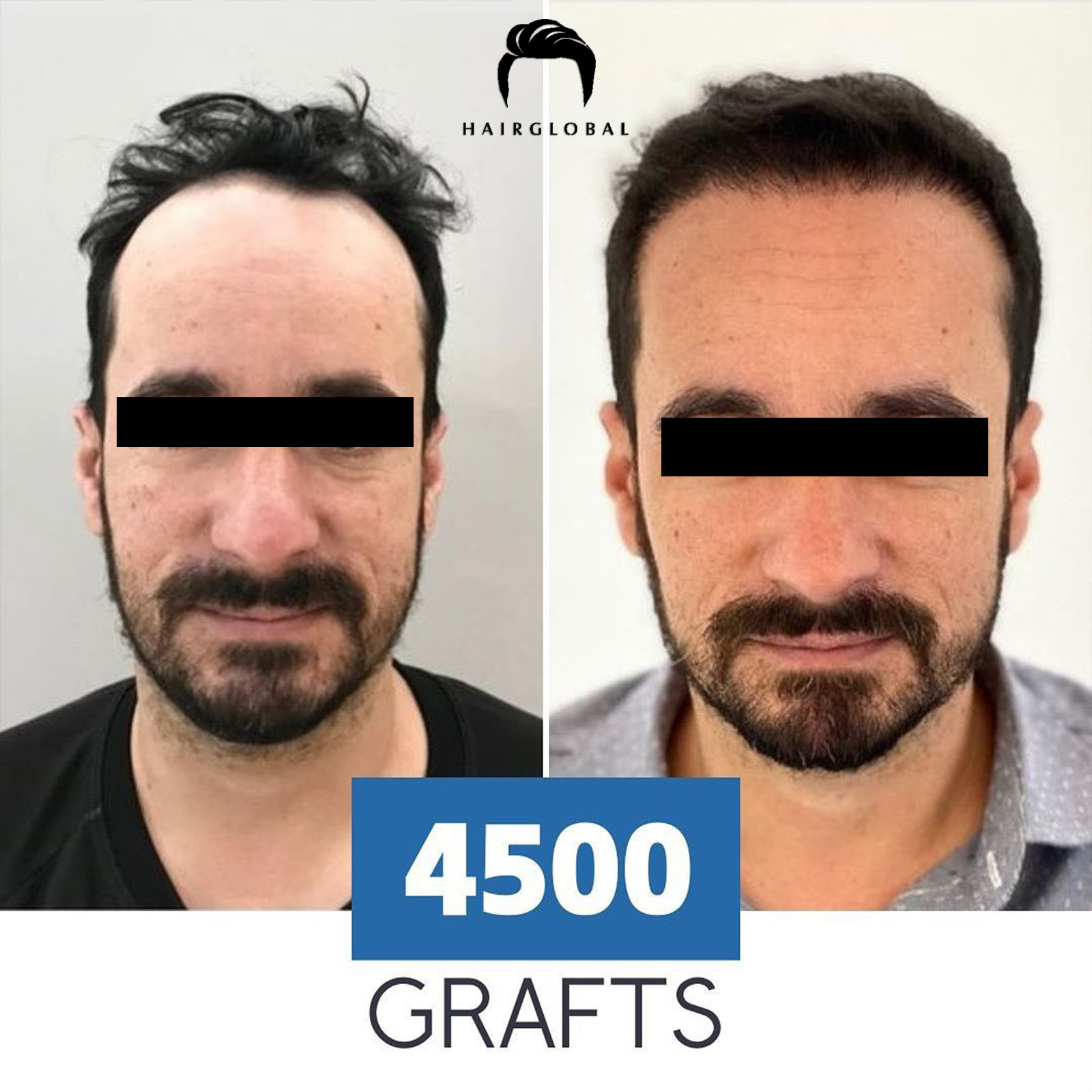 FUE — HairGlobal