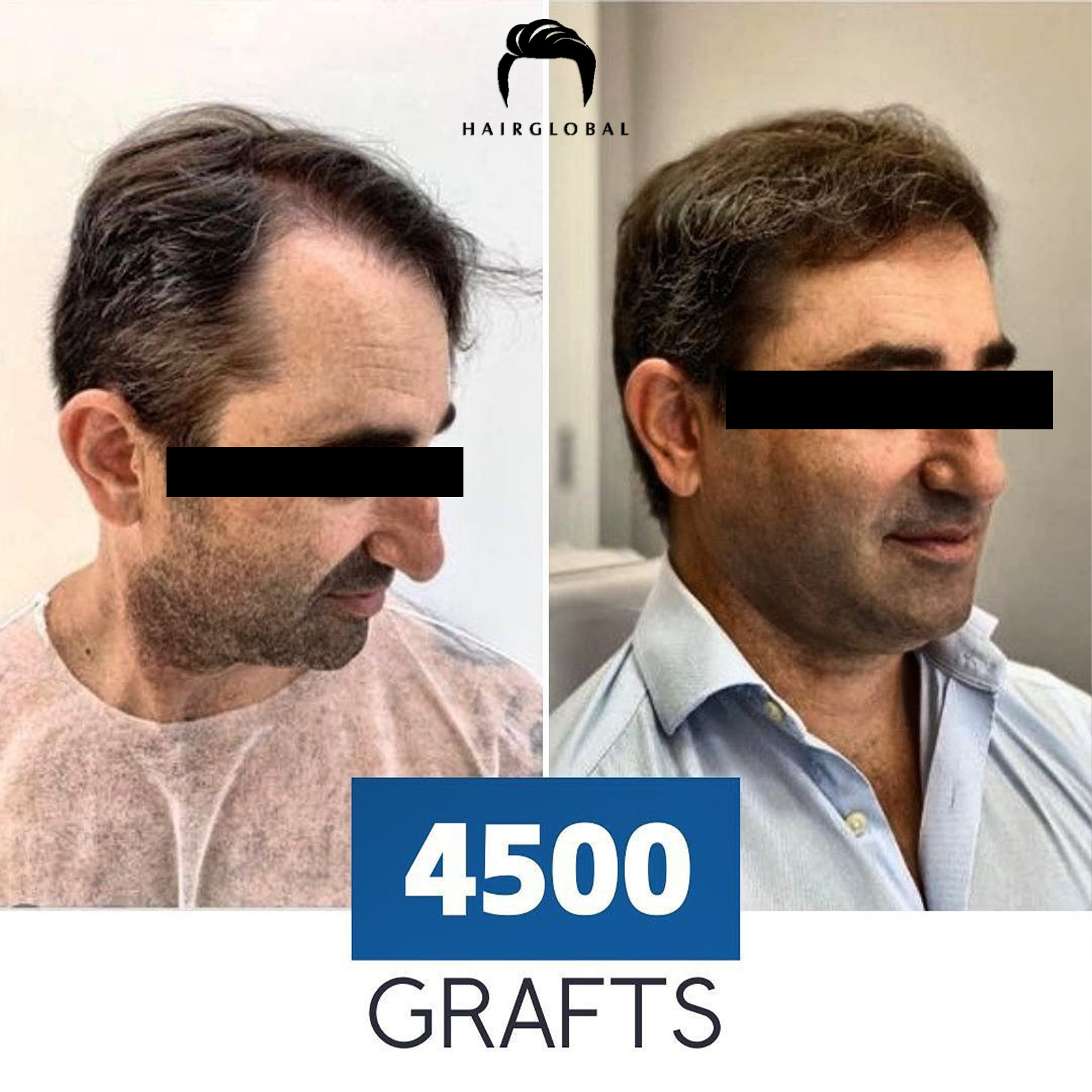 FUE — HairGlobal