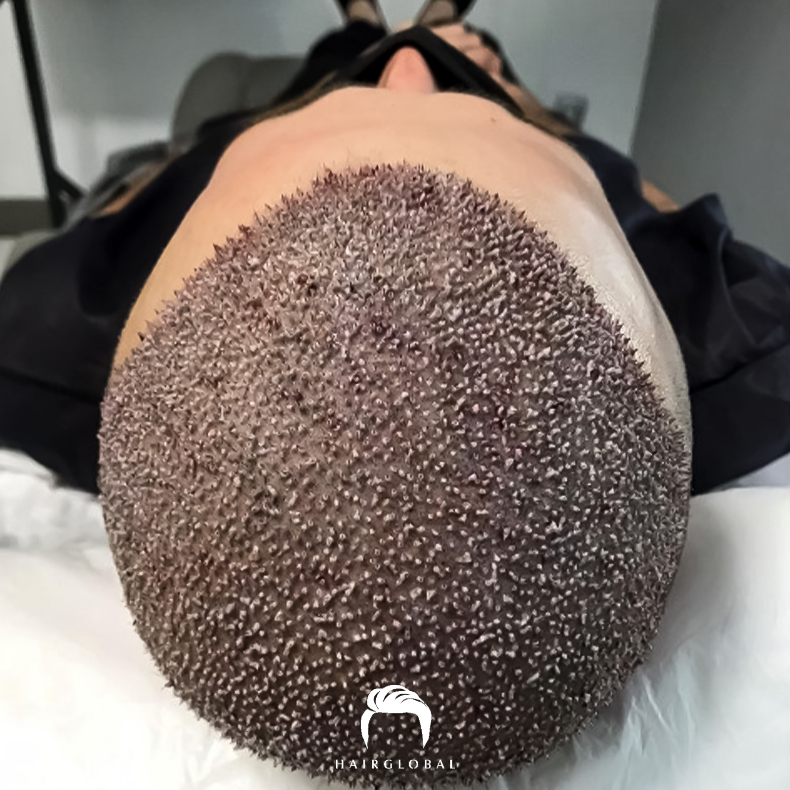 FUE — HairGlobal