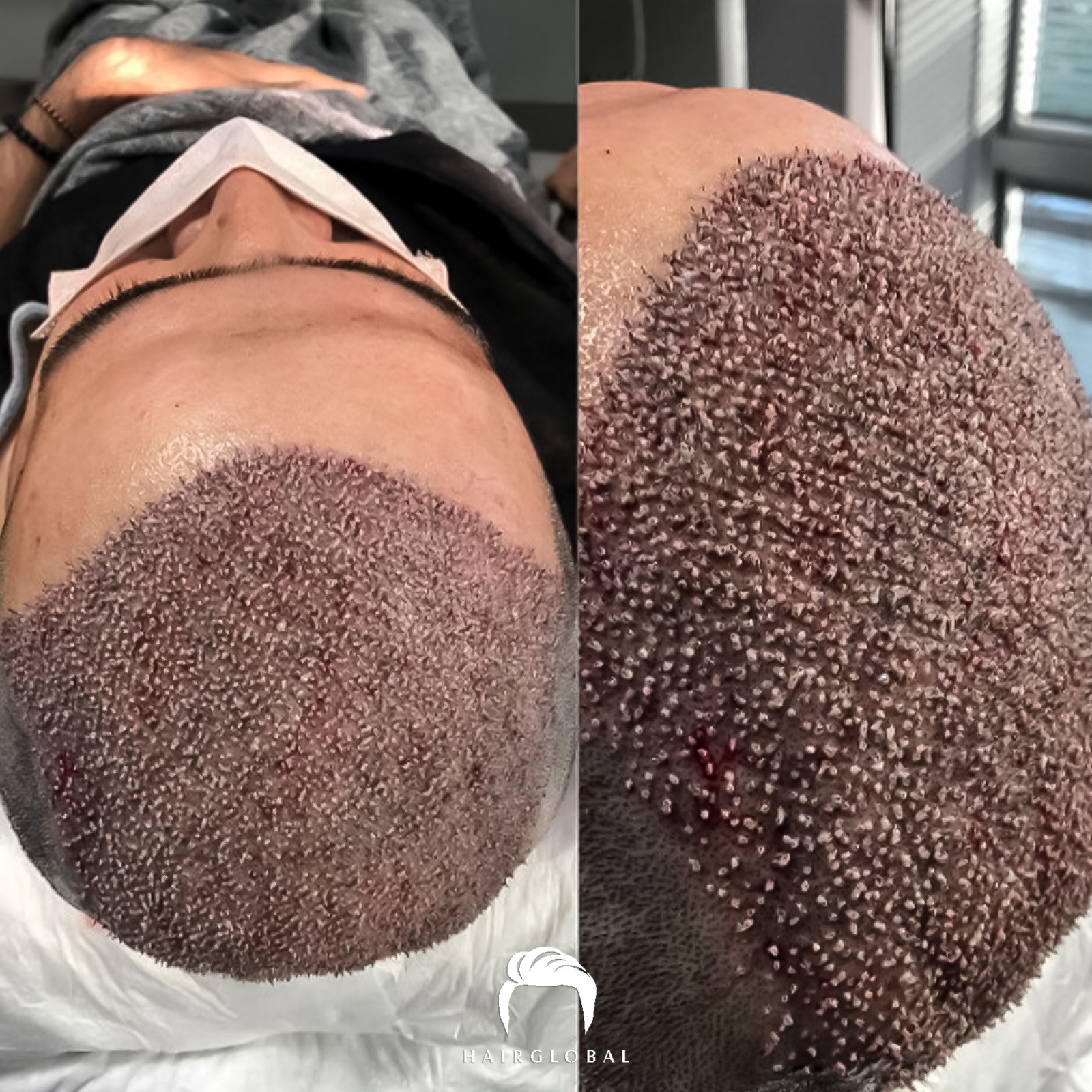 FUE — HairGlobal