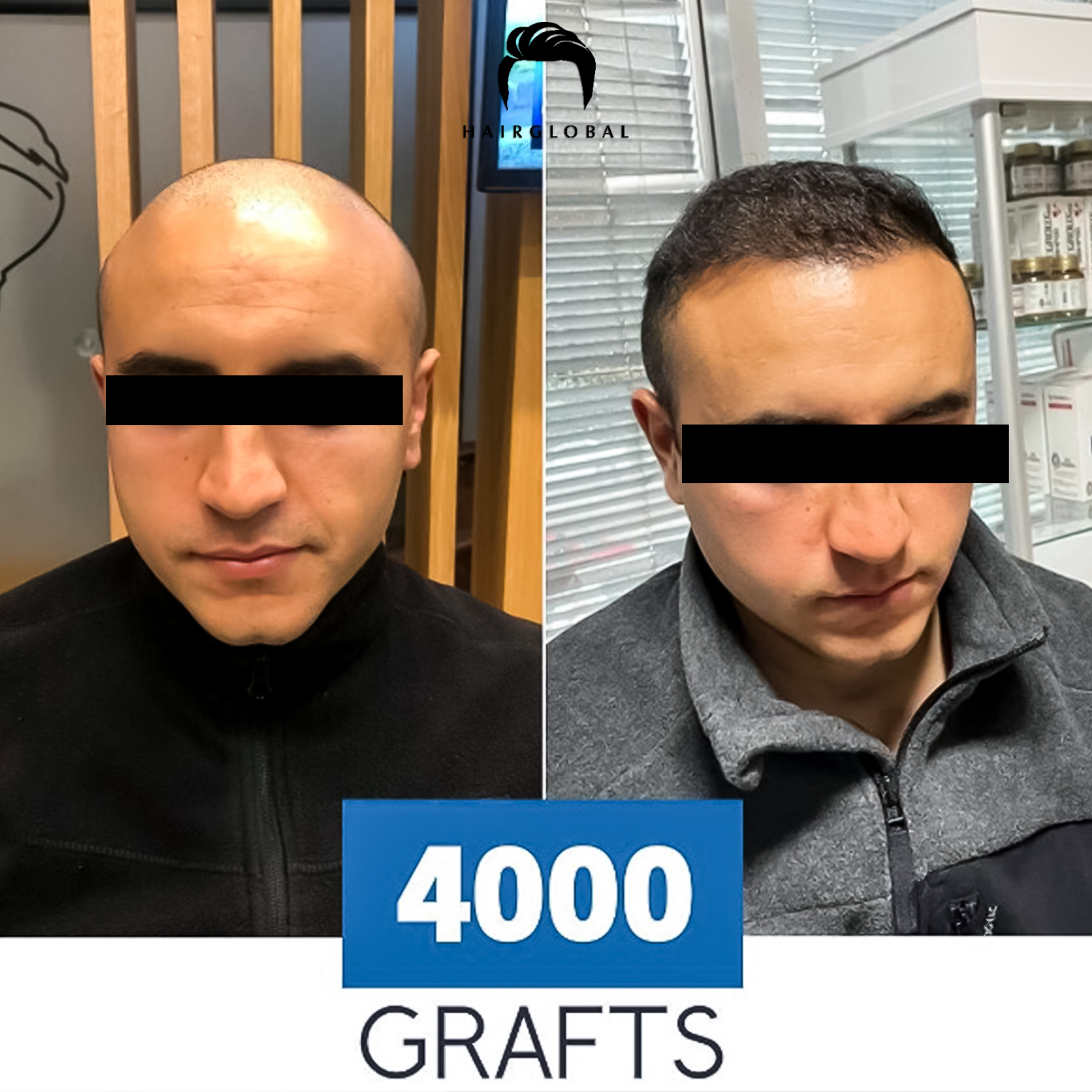 FUE — HairGlobal