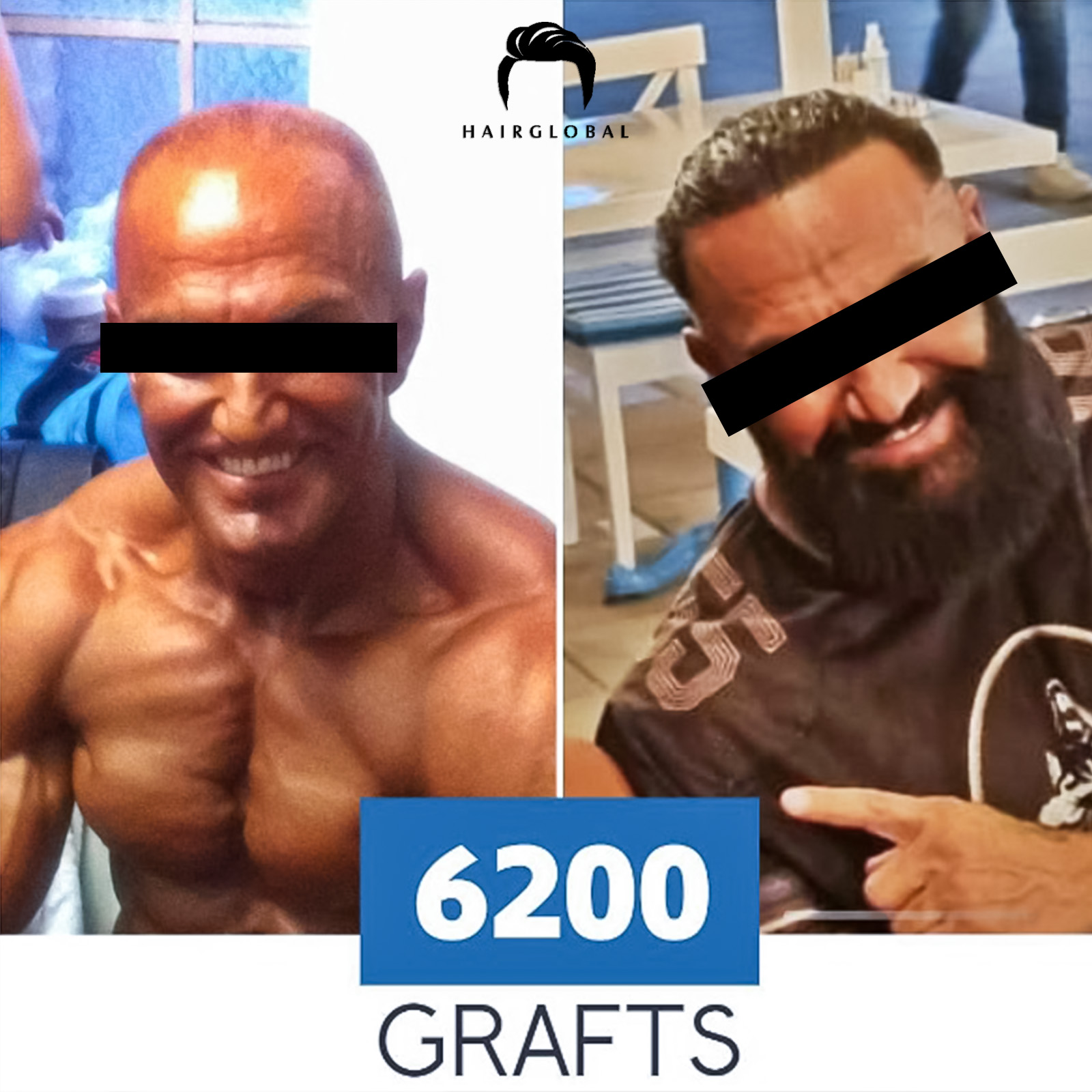FUE — HairGlobal