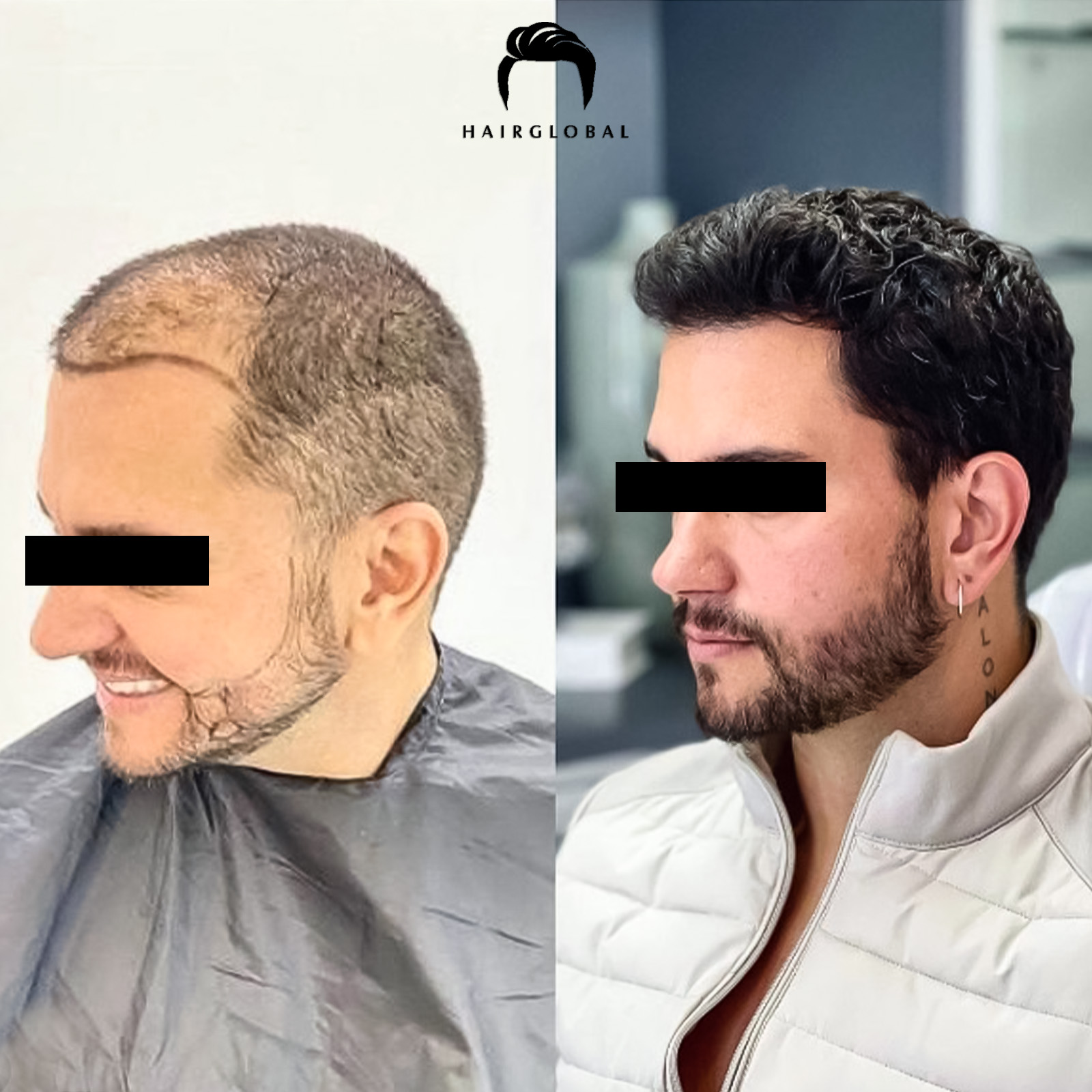 FUE — HairGlobal