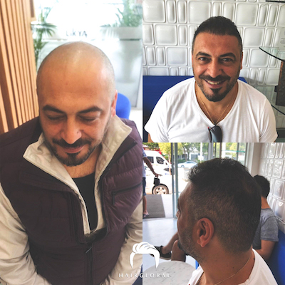 FUE — HairGlobal
